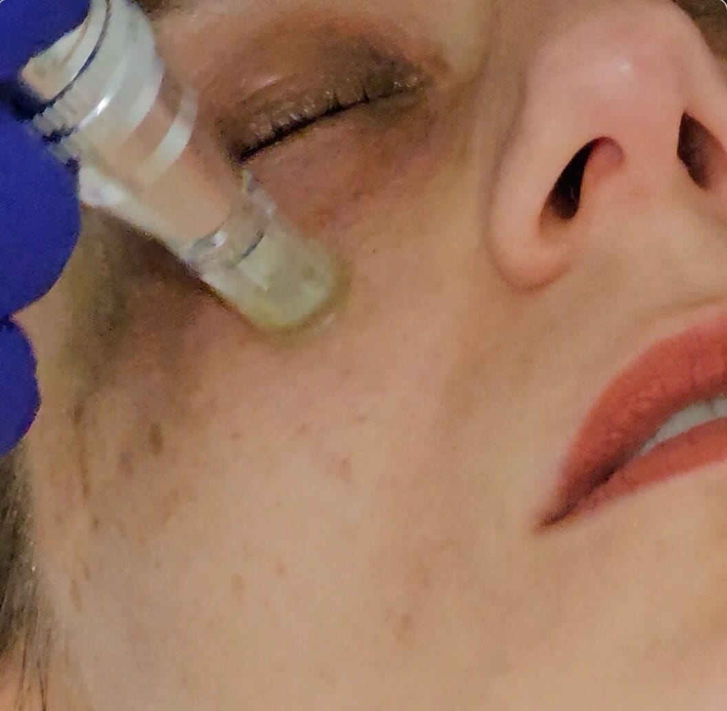 peeling-cerne Le Dr effectuant un peeling sur un cerne coloré au cabinet de Nîmes