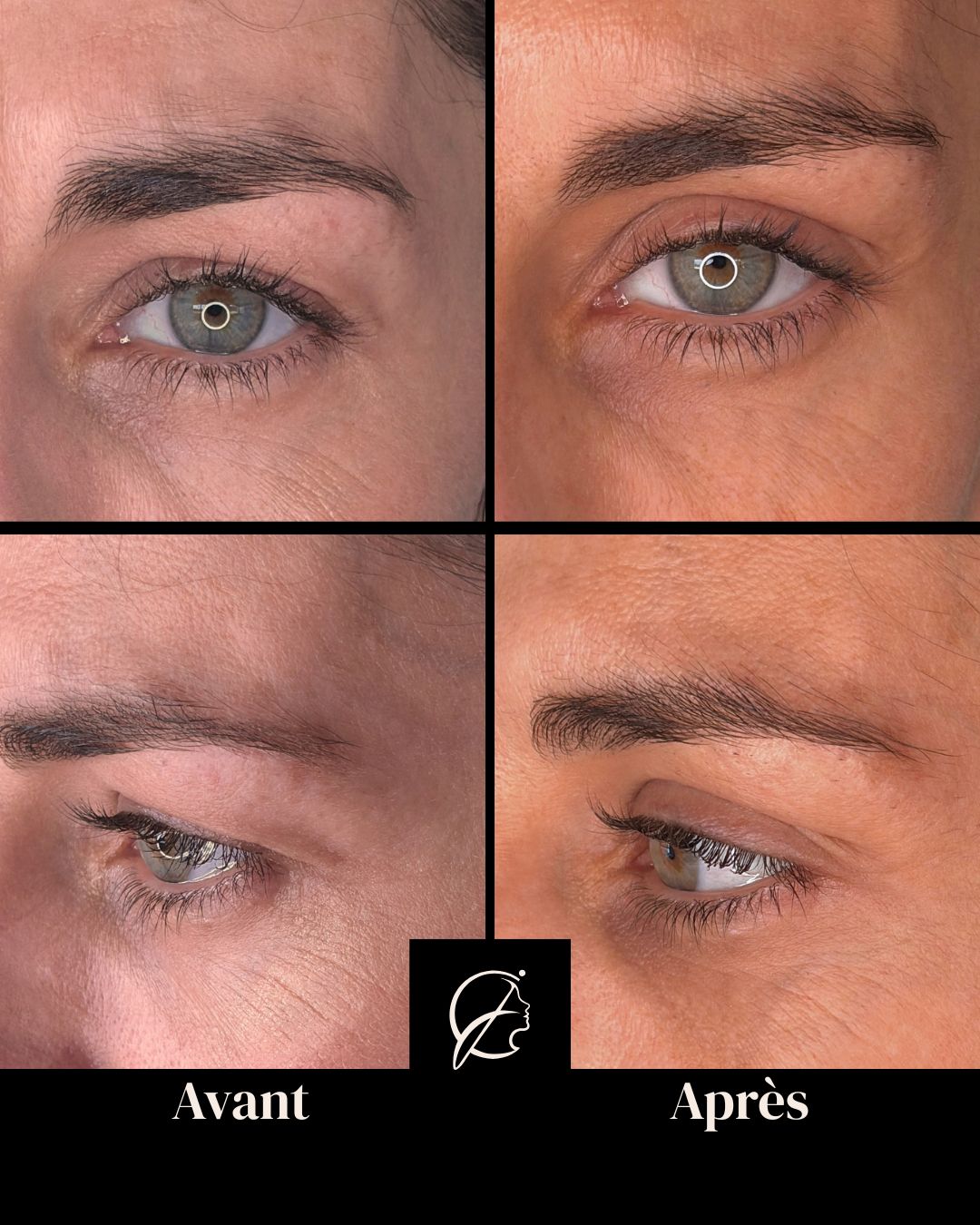 blepharo-medicale-1 Comparaison avant et après blepharoplastie médicale au laser Erbium — œil droit. Vue de face et de profil montrant l'amélioration du relâchement cutané de la paupière supérieure et le regain de définition du regard.